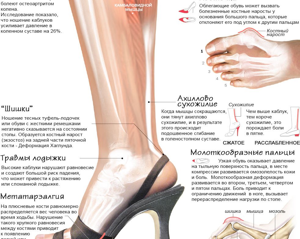 ИНФОГРАФИКА: как высокие каблуки влияют на ваше здоровье